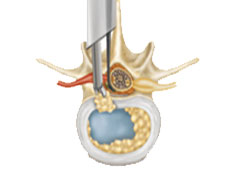 https://drbarani.com/wp-content/uploads/2024/05/aggressive-discectomy.jpg