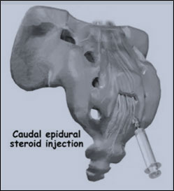 https://drbarani.com/wp-content/uploads/2024/05/caudal-epidural-injection-.jpg