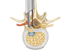 https://drbarani.com/wp-content/uploads/2024/05/discectomy.jpg