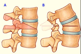 https://drbarani.com/wp-content/uploads/2024/05/pedicle-subtraction-osteotomy.jpg