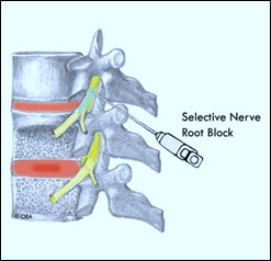 https://drbarani.com/wp-content/uploads/2024/05/selective-nerve-root-block.jpg