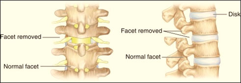 https://drbarani.com/wp-content/uploads/2024/05/smith-petersen-osteotomy.jpg