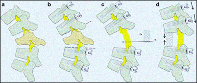 https://drbarani.com/wp-content/uploads/2024/05/vertebral-column-resection-osteotomy.jpg